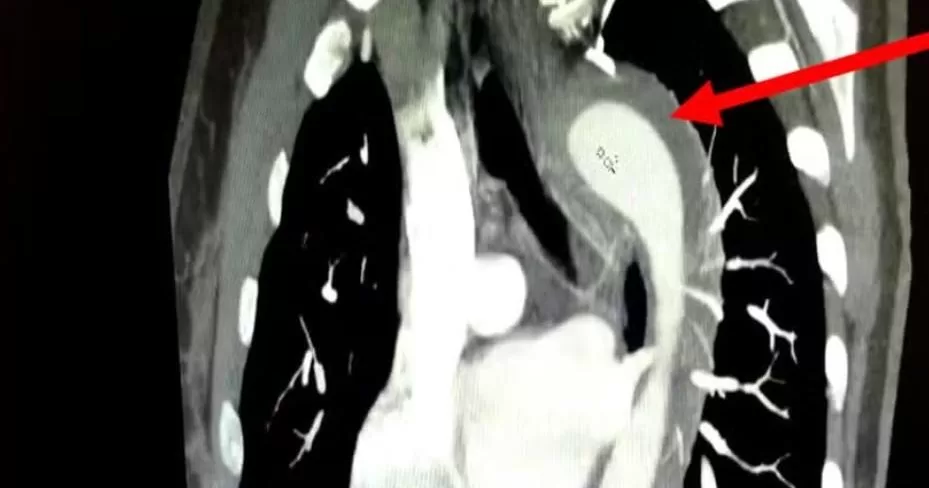Mulher-sofre-ruptura-de-aorta-apos-orgasmo-durante-relacao-sexual-aspect-ratio-40-21