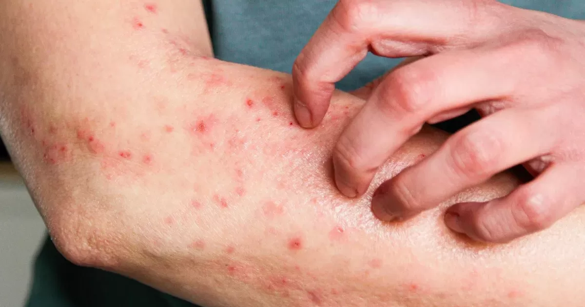eczema-mpox-aspect-ratio-40-21